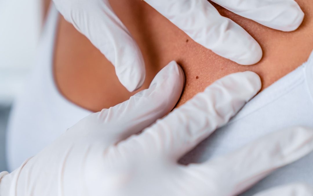 Skin Check and Skin Cancer Clinic